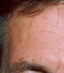 Na foto pigmentvlekken behandeling