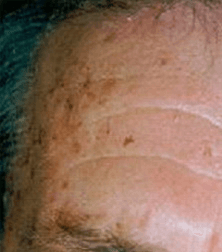 Voor foto pigmentvlekken behandeling